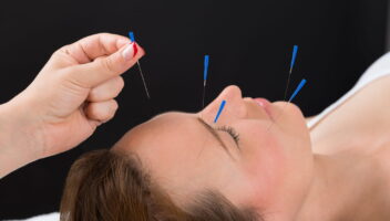 acupuntura enxaqueca