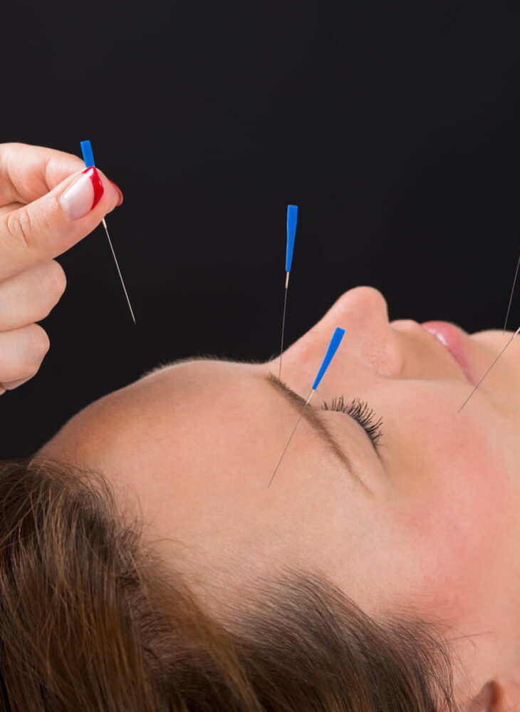 acupuntura enxaqueca