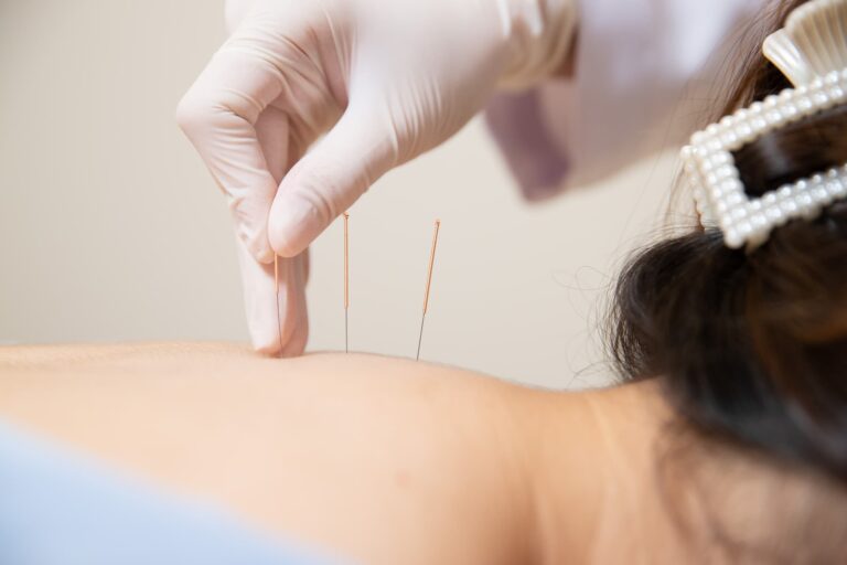 Acupuntura para tendinite e bursite: quando considerar e como acompanhar