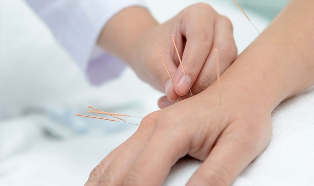 Imagem do artigo: Quanto tempo dura uma sessão de acupuntura médica?