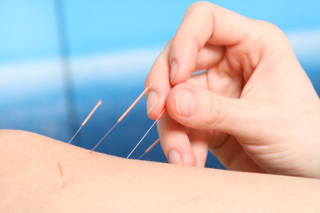 Imagem do artigo: Acupuntura no lúpus: sintomas, atividade da doença e segurança